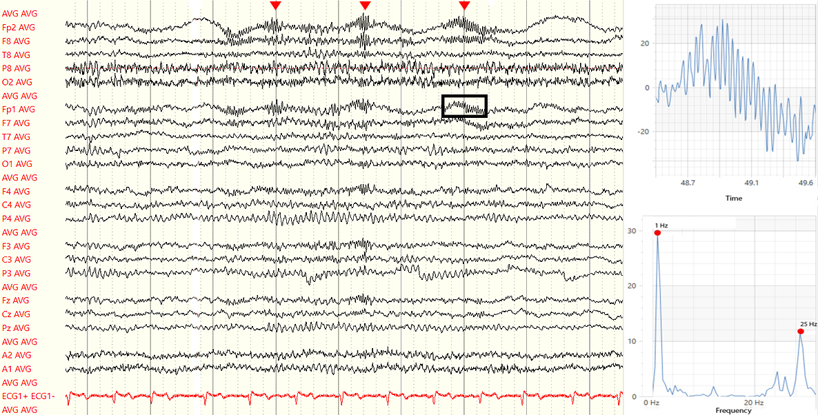 IFCN and its Clinical Neurophysiology journals tweet media