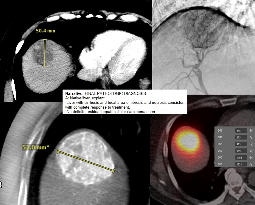 ZTBerman's tweet photo. Another example of an ablative TARE for #HCC. Rad seg for a 5 cm tumor with median tumor dose > 1000 Gy. Transplanted with CPN. No additional treatments. The future of HCC care. No longer just bridge to xplant- but optimize xplant. @SIRspecialists @ucsd_ir https://t.co/kltewOrekK