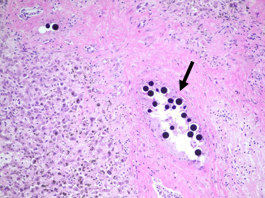Case of the Week: An elderly female was found to have a 7 cm liver lesion at autopsy.  What is the histologic finding indicated by the arrow?

surveymonkey.com/r/FXTVDLP
