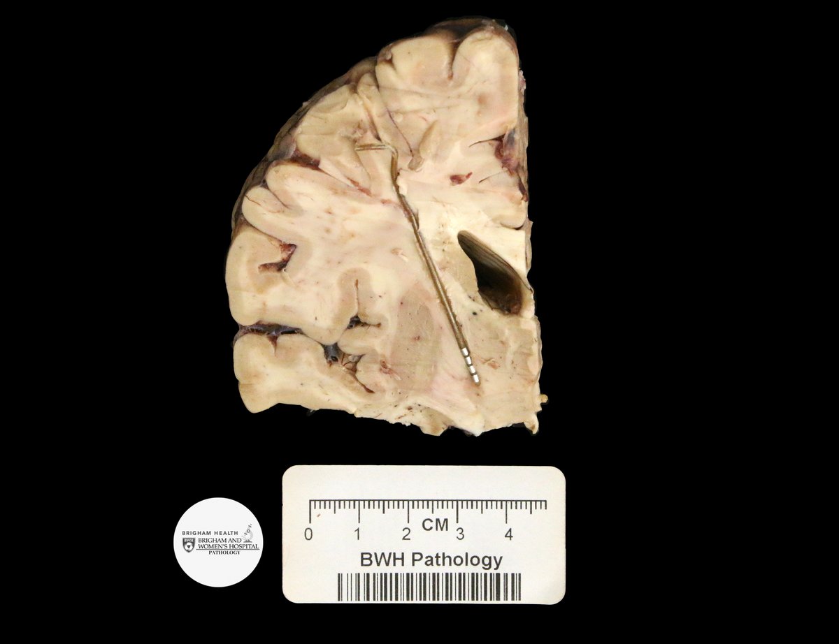 Hello and welcome to the Gross Case of the Week – Neuro Winter Edition! This week we have a case from autopsy. Can you guess what is pictured here? #GrossCOTW #NeuroWinter