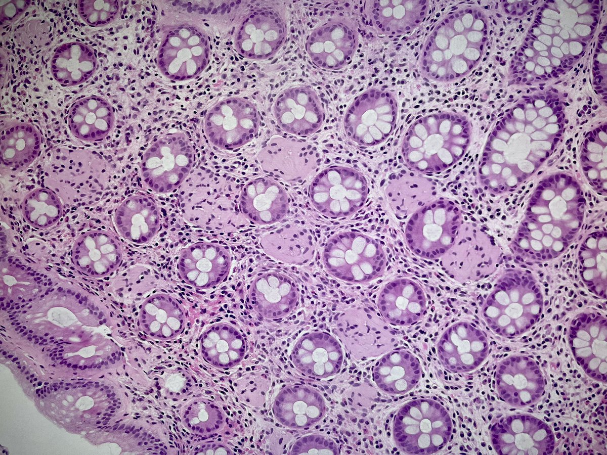 I don’t often post histology but this was too pretty to resist - what do you think #PathTwitter? 56 year old male, vaguely polyploid area in sigmoid colon.