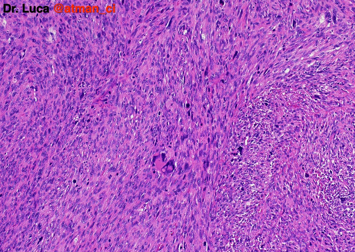 atman_ci's tweet photo. Two 'hot' #BSTPath cases to warm up your weekend! N°1: 45yF, thigh mass, deep located. Your differentials? Any IHCs? @PoloniaAntonio @caseypschukow @SumantaDas_7 @LoboAnandi @Romanow_MD @shahidi_hossein @DrGeeONE @NeoCrazee @sumeyra_md @DrNishatAfroz2 #PathTwitter #pathresidents https://t.co/1SWtYDVtL8