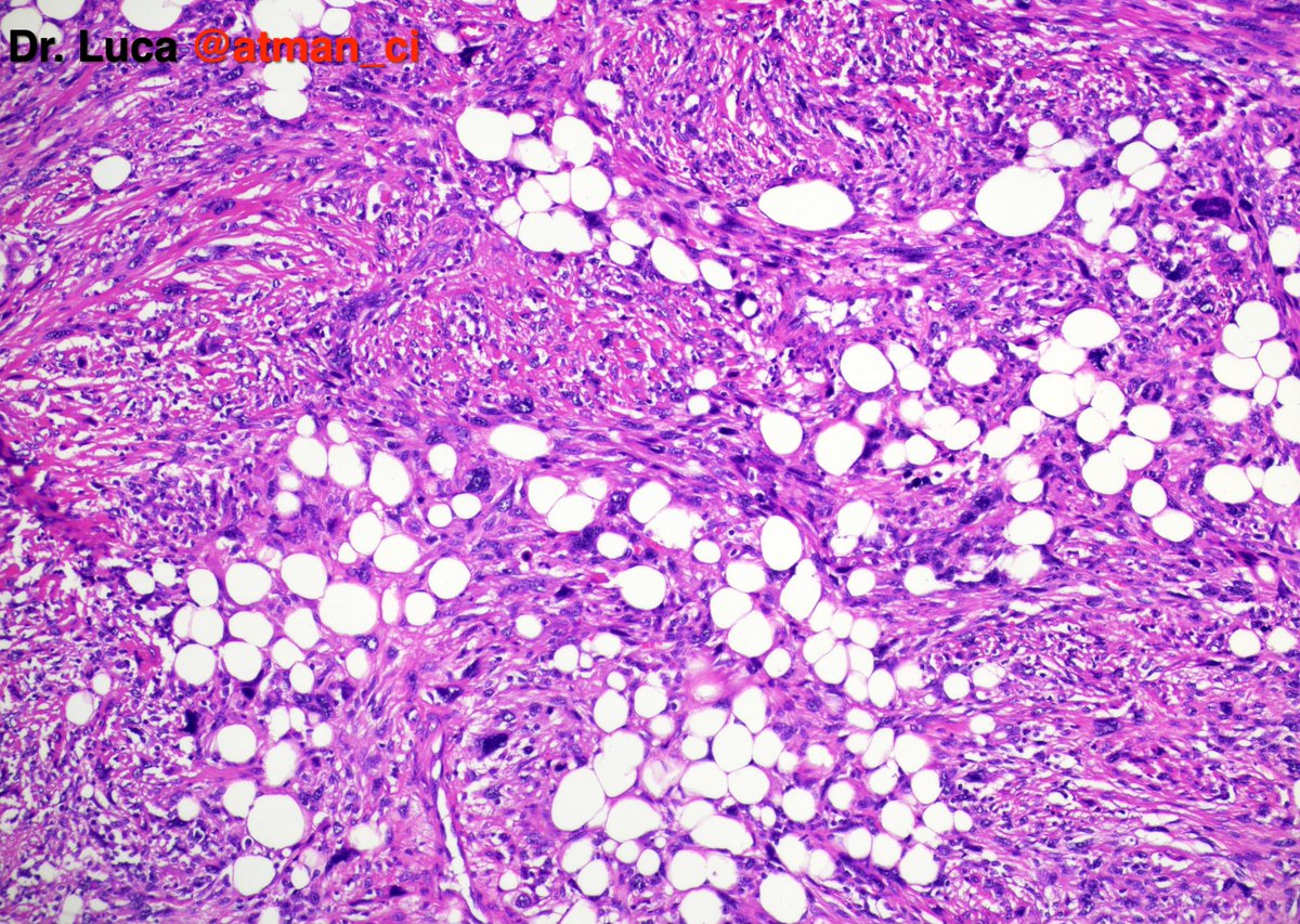 atman_ci's tweet photo. Two 'hot' #BSTPath cases to warm up your weekend! N°1: 45yF, thigh mass, deep located. Your differentials? Any IHCs? @PoloniaAntonio @caseypschukow @SumantaDas_7 @LoboAnandi @Romanow_MD @shahidi_hossein @DrGeeONE @NeoCrazee @sumeyra_md @DrNishatAfroz2 #PathTwitter #pathresidents https://t.co/1SWtYDVtL8