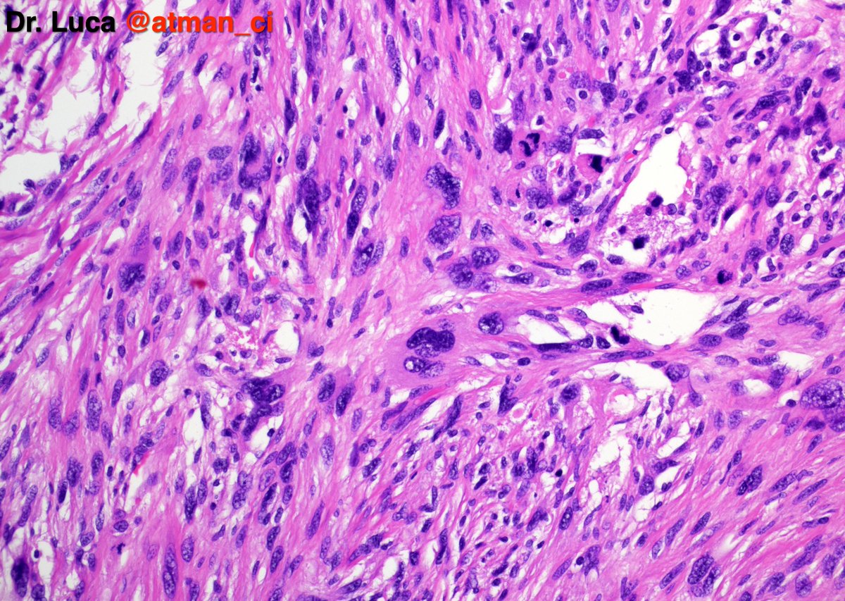 atman_ci's tweet photo. Two 'hot' #BSTPath cases to warm up your weekend! N°1: 45yF, thigh mass, deep located. Your differentials? Any IHCs? @PoloniaAntonio @caseypschukow @SumantaDas_7 @LoboAnandi @Romanow_MD @shahidi_hossein @DrGeeONE @NeoCrazee @sumeyra_md @DrNishatAfroz2 #PathTwitter #pathresidents https://t.co/1SWtYDVtL8