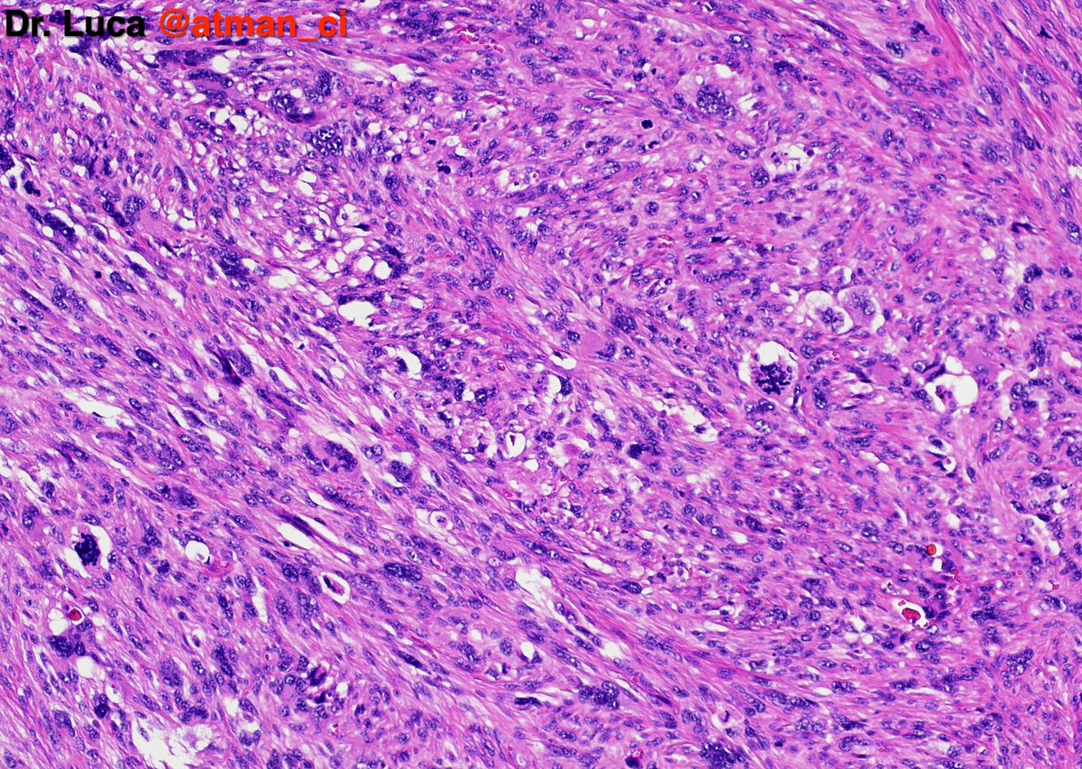 Two 'hot' #BSTPath cases to warm up your weekend! N°1: 45yF, thigh mass, deep located. Your differentials? Any IHCs? <a href="/PoloniaAntonio/">A. Polónia</a> @caseypschukow <a href="/SumantaDas_7/">Sumanta Das</a> <a href="/LoboAnandi/">Anandi Lobo, MD</a> <a href="/Romanow_MD/">Aleksandr Romanov</a> <a href="/shahidi_hossein/">M.hossein shahidi</a> <a href="/DrGeeONE/">Olaleke Folaranmi</a> <a href="/NeoCrazee/">SANO Naoki, MD, Pathologist, Japan</a> <a href="/sumeyra_md/">Sumeyra Kartal</a> <a href="/DrNishatAfroz2/">Nishat Afroz MD</a> #PathTwitter #pathresidents
