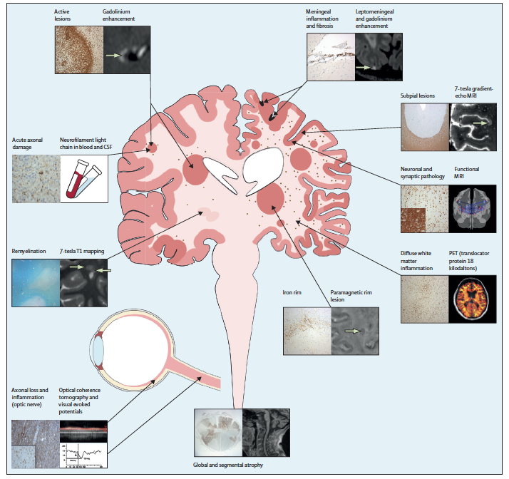 anneke_vdw's tweet photo. Multiple sclerosis progression: time for a new mechanism-driven framework https://t.co/hh6cgAe1Ig https://t.co/OGWcXtCSK9