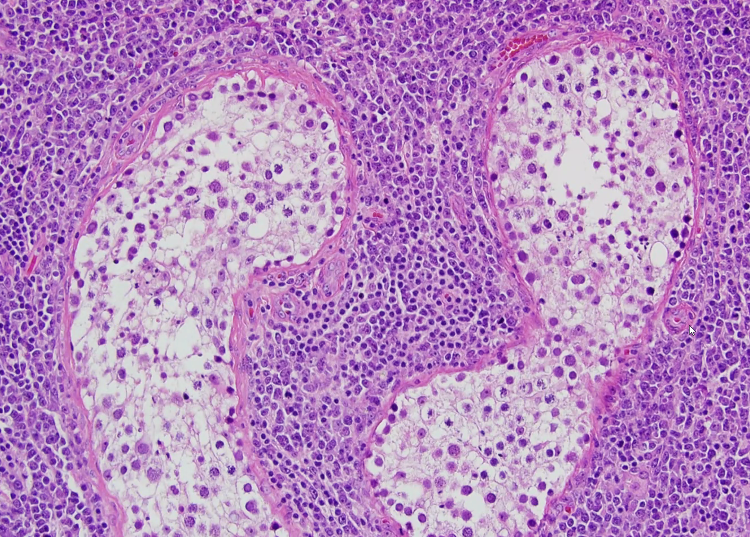 megothelioma tweet picture