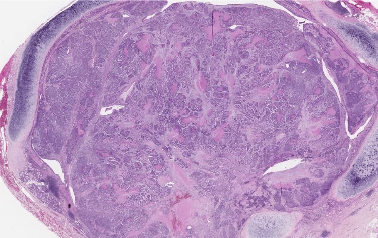 megothelioma's tweet photo. Nice example of basaloid squamous cell carcinoma in this lung specimen. Classic "squamous" morphology is limited in these cases and instead we see nests of high N:C ratio cells with peripheral palisading.
#PathTwitter #ThoracicPath #BasicPath https://t.co/oem6KRksnS