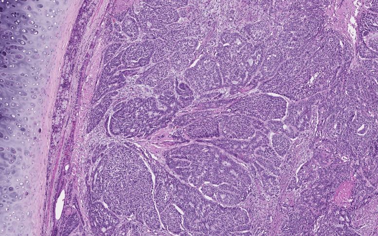 megothelioma's tweet photo. Nice example of basaloid squamous cell carcinoma in this lung specimen. Classic "squamous" morphology is limited in these cases and instead we see nests of high N:C ratio cells with peripheral palisading.
#PathTwitter #ThoracicPath #BasicPath https://t.co/oem6KRksnS
