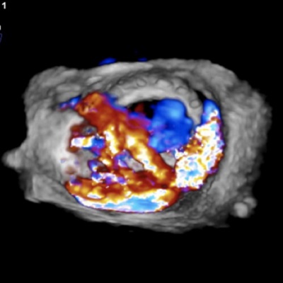 DeBakeyCVedu's tweet photo. New #DeBakeyCVJournal case report! Percutaneous Management of Bioprosthetic MV Dehiscence with Combined Valve-in-Valve Replacement &amp; Paravalvular Leak Closure by Jack Xu @hani_alturkmani @ChausAdib S Vallurupalli, Gaurav Dhar @UAMS_Cardio 

https://t.co/8nrKALfX5I
#cardiotwitter https://t.co/FKyJe2VZiU