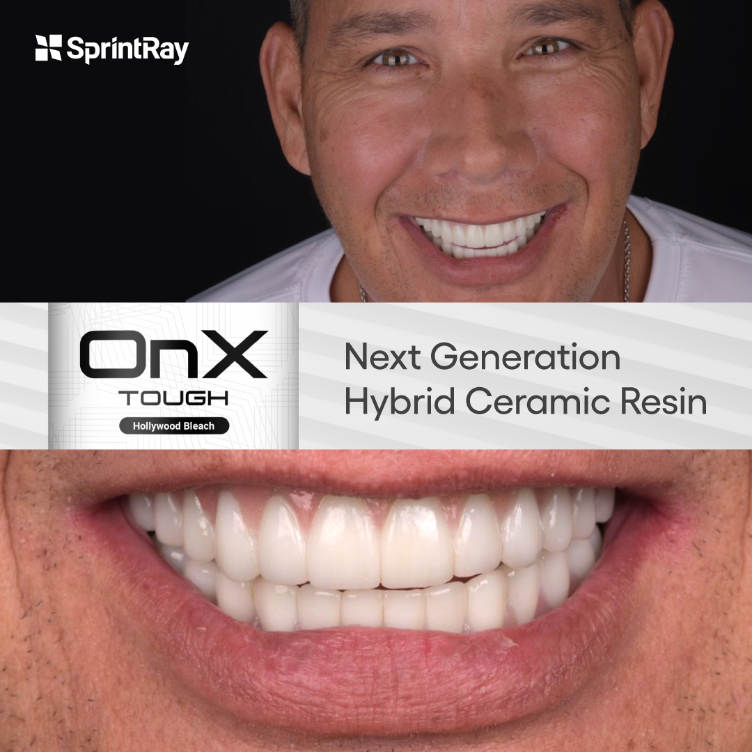 Rick’s smile is a testament to the power of #3Dprinting with SprintRay’s OnX Tough🦷
Justin McElroy helped Rick obtain a same-day smile to match his ebullient persona.