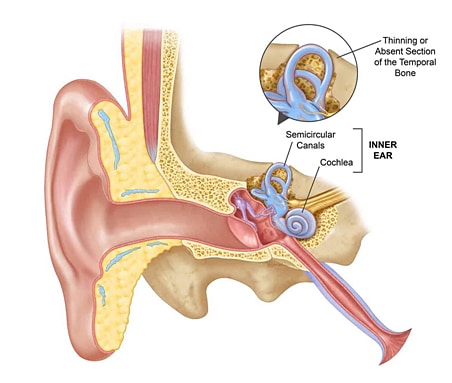 Semicircular canal dehiscence is a rare condition caused by a hole in the bone surrounding a balance organ in your inner ear. Causes balance and hearing symptoms.

Learn more on on our website!

#vertigo #physiotherapy #dizziness #vestibular #health #medicine #ENT