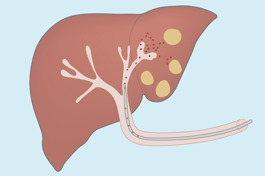 Liver lesions are abnormal growths that occur for a variety of reasons. Some are noncancerous (benign), and others are cancerous. Many benign lesions do not need treatment.
#liverlession #abnormalgrowth #noncancerous #liverdisease #endorinology