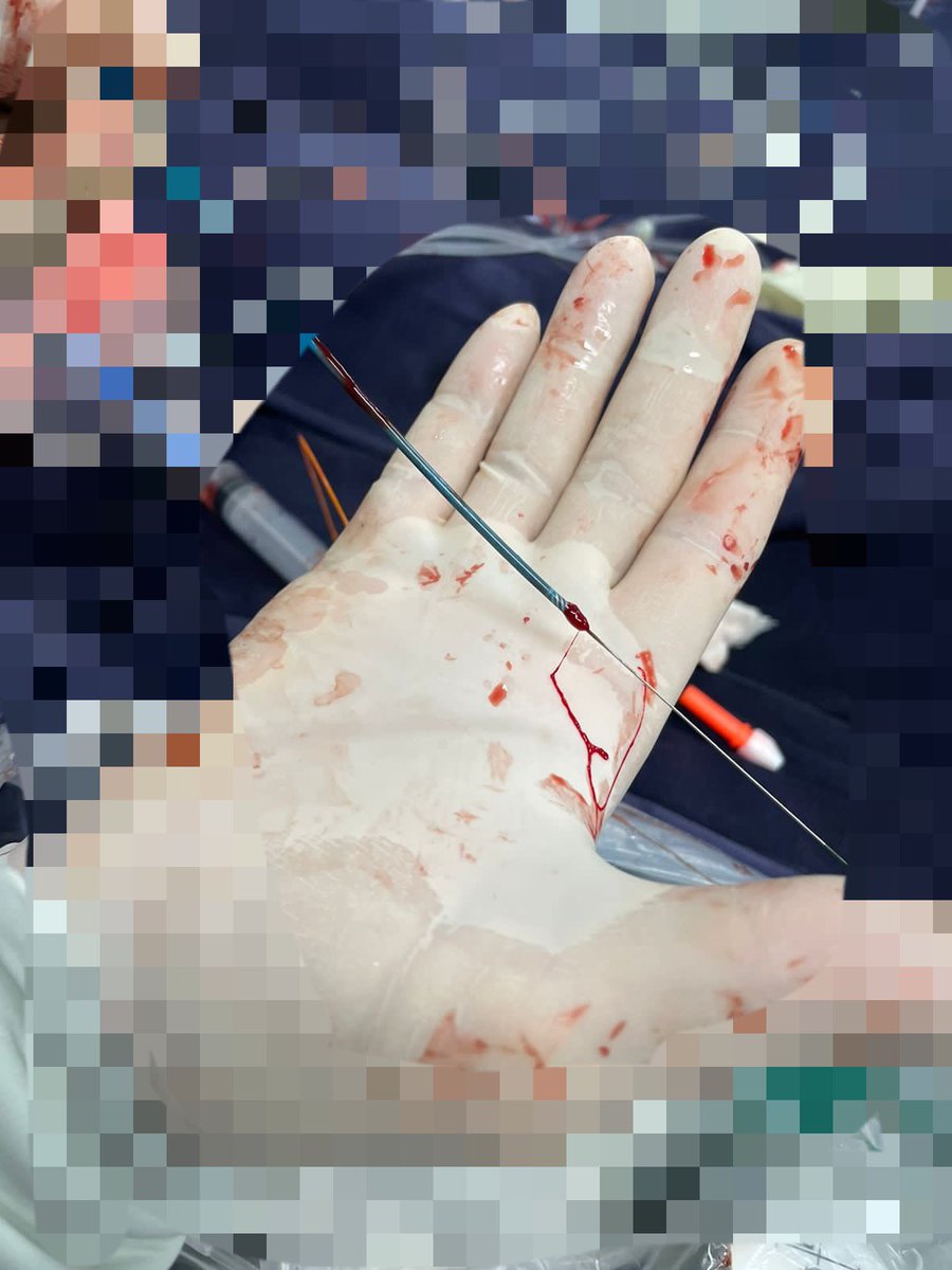Guide extension catheter thrombosis at collar site with ACT &gt;&gt; 400. Unfortunately this isn’t a rare finding in complex &amp; prolonged procedures.
