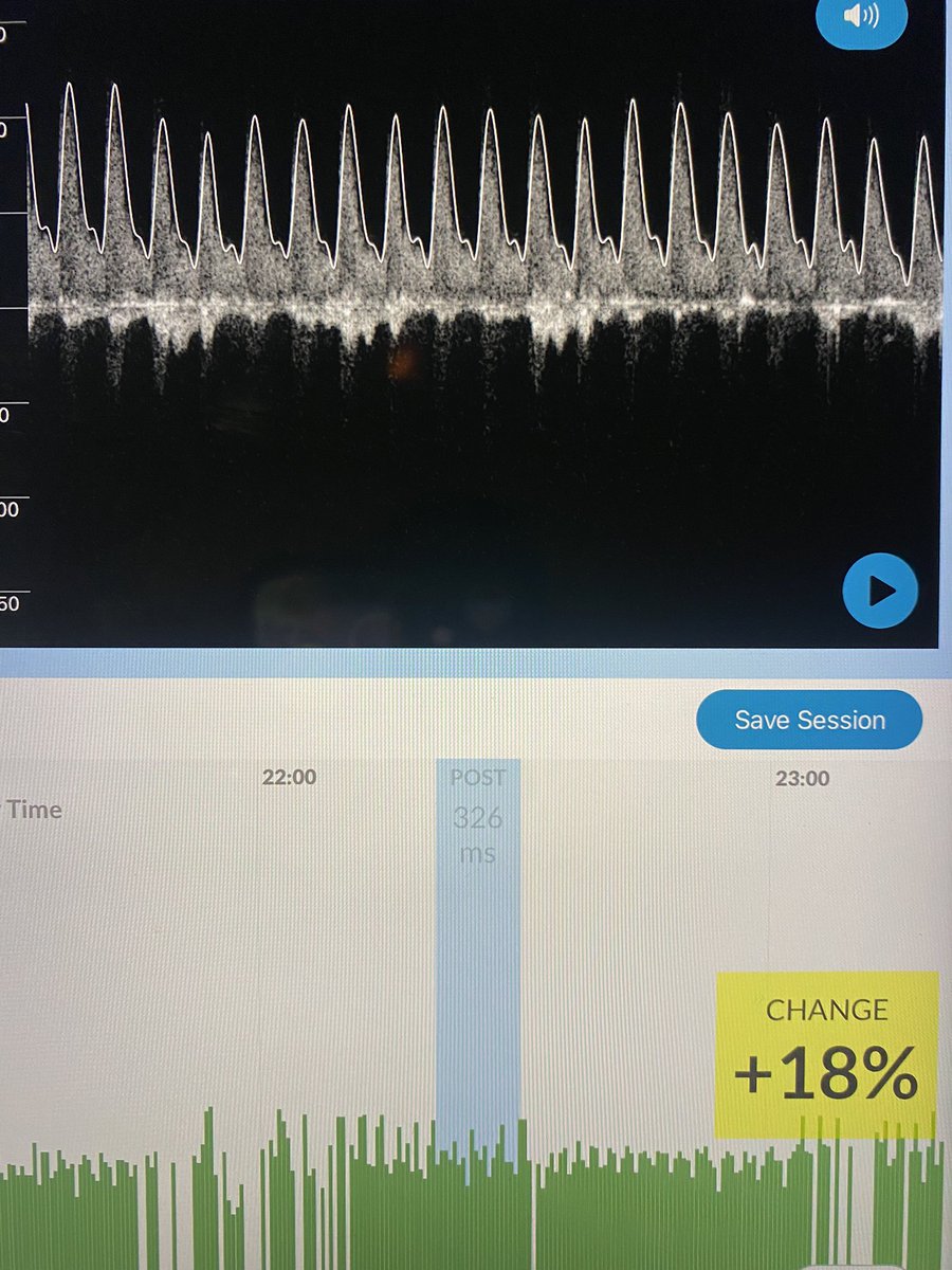 Philippe Rola (@thinkingcc) on Twitter photo 65F w dyspnea and hypotension. For the Doppler-phile resuscitationists out there… what did I do between the two? Ping <a href="/khaycock2/">korbinhaycockmd</a> <a href="/Flosonics/">FloPatch | Flosonics Medical</a> <a href="/ross_prager/">Ross Prager</a> 65F w dyspnea and hypotension. For the Doppler-phile resuscitationists out there… what did I do between the two? Ping <a href="/khaycock2/">korbinhaycockmd</a> <a href="/Flosonics/">FloPatch | Flosonics Medical</a> <a href="/ross_prager/">Ross Prager</a>