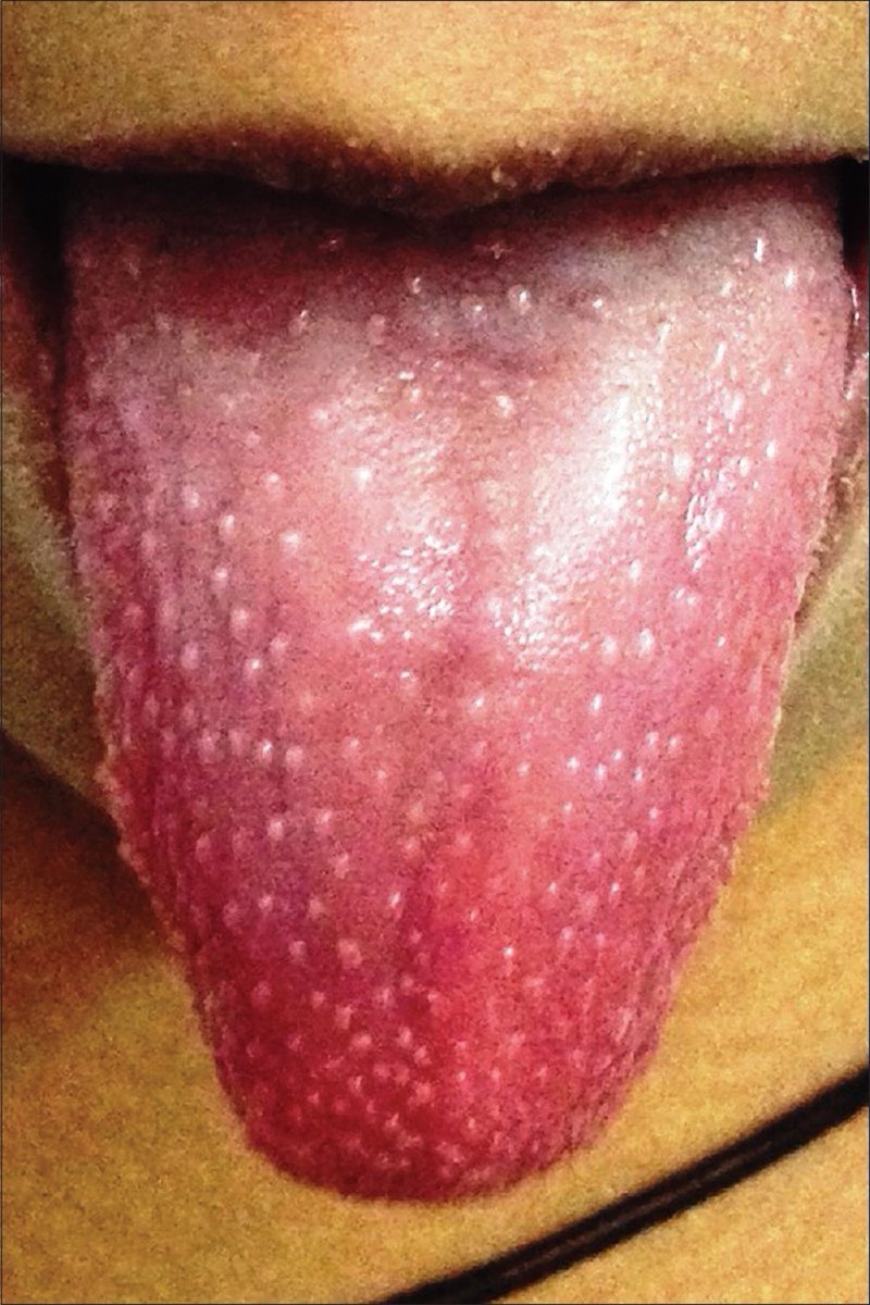 BrownJHM's tweet photo. An 10-year-old girl came with 1 week hx of fever &amp; rash. She had a diffuse macular rash, fissured lips, conjunctival injection in both eyes, enlarged cervical LN, erythema of the palms &amp; soles &amp; periungual desquamation. What is the diagnosis?#Medtwitter #Pediatrics (Image: IJDVL) https://t.co/oQZCt5phuh