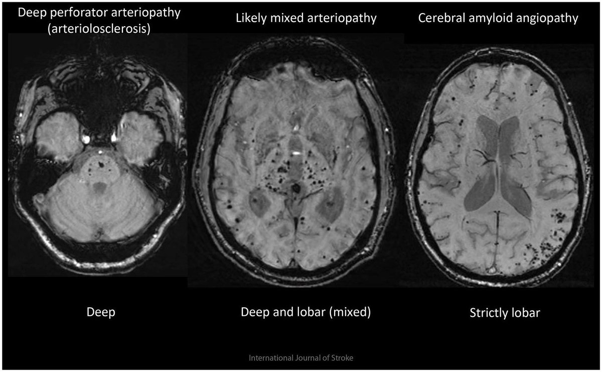 ⚫️Microbleed patterns / 🪱SVD type
associated w intracerebral hemorrhage 

via @IntJStroke

SVD=Small vessel disease 🧠

#NeuroTwitter #stroke #neurology #Neurosurgery #NeuroRad #MedTwitter #neuroradiology #dementia @microbleeds #AmyloidAngiopathy