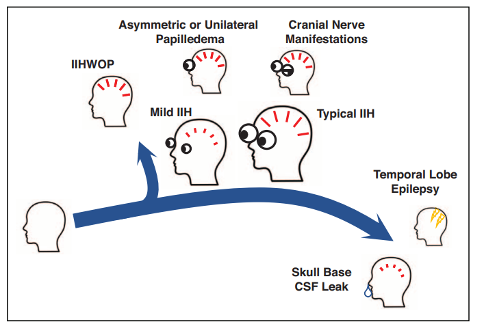 Idiopathic intracranial hypertension (IIH): a spectrum? 🥸🧠🤔

WOP: without papilledema. 

#Neuro #Neurology #NeuroTwitter #EndNeurophobia
#Education #Headache #IHH