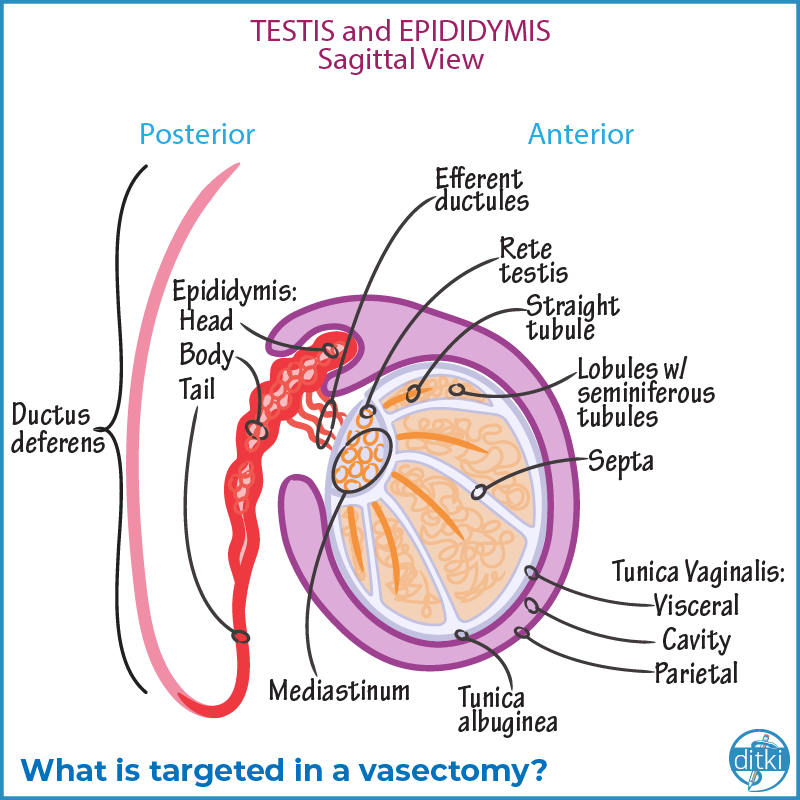 Learn more: l8r.it/EEUp

#ditki #usmle #meded #medschool #medstudent #reproduction #birthcontrol #vasectomy #medicalschooltutorials
#nursing #pance #physicianassistant #osteopath #allopath #medicine #science #healthscience #nurse #premed #mcat #mbbs