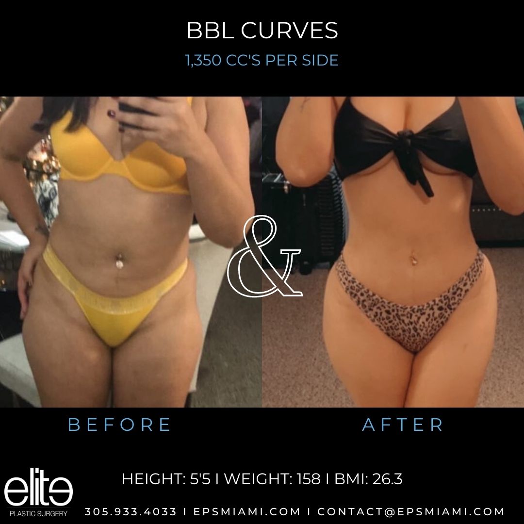 EPSMiami's tweet photo. Beautiful #BBL curves by Dr. Salama π¨π»ββοΈ! This Elite Queen π is looking snatched ππ»
π» https://t.co/zRKQqiKfhd
π 305.933.4033
π§ contact@epsmiami.com
#brazilianbuttlift #buttaugmentation #plasticsurgery #miamiplasticsurgery https://t.co/li63ivCQw1
