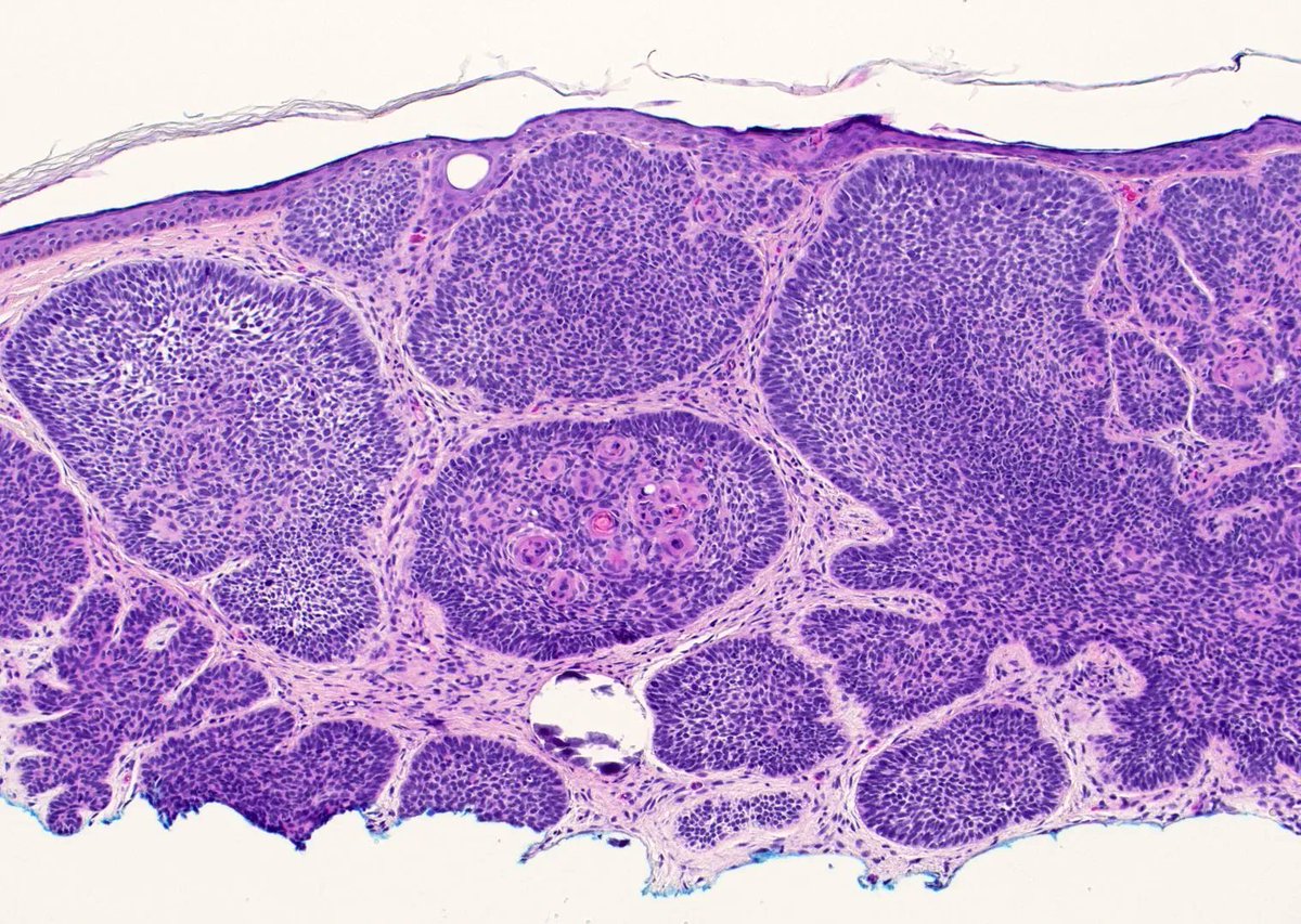 Jerad Gardner, MD on Twitter "Check out my basal cell carcinoma sample