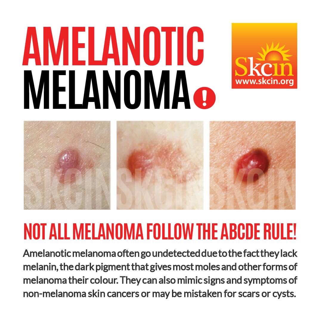 SkcinCharity's tweet photo. Whilst amelanotic melanoma is relatively uncommon fatality rates tend to be higher because they often go undetected for longer, are often misdiagnosed because they mimic other skin lesions and are therefore commonly diagnosed at later stages. https://t.co/cAzYIsuTAo https://t.co/XFdGh9V7VM