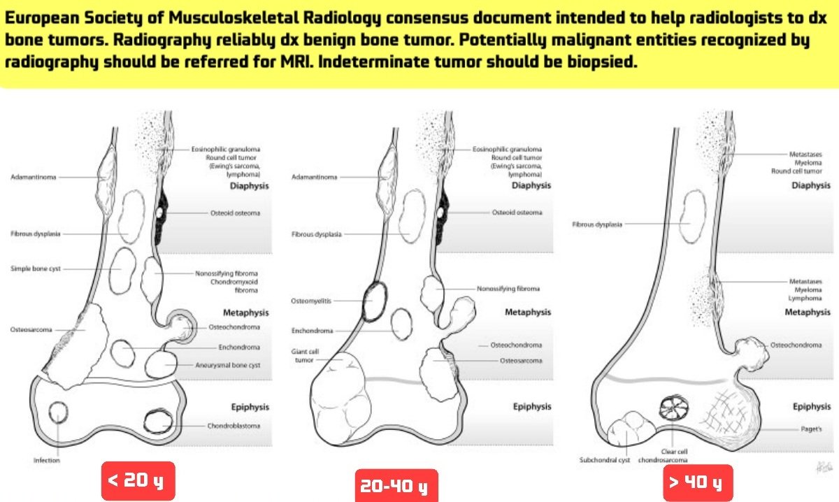 OBandarchi's tweet photo. 🛑I love these 3 illustrations that based on the age &amp; location of bone tumors offered the differential diagnosis.👍👏
https://t.co/fVuhWLsXT3
🌟This wonderful document that I put its link above, prepared by the European Society of Musculoskeletal Radiology to help radiologists https://t.co/tnLmunt6IR
