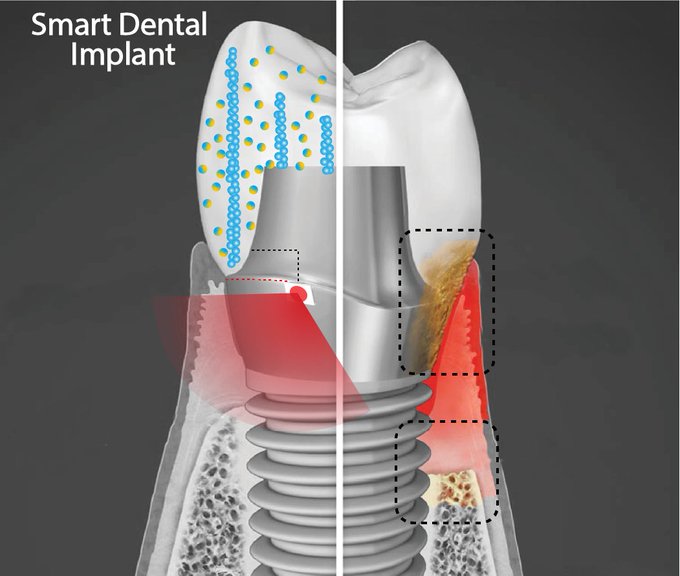 Умный зубной имплант