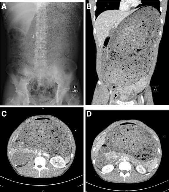 Hamburguesa de 3.2 kg digerida en 30 min en concurso 🍔
Imágenes de Radiografía y TC a las 8 h. con estómago y duodeno proximal muy distendidos.
Se realizan lavados por SNG y el paciente logró mover sus intestinos, y alta hospitalaria 5 días después

Caso gastrojournal.org/article/S0016-…