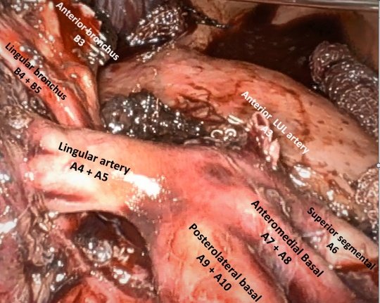 LUL ligula sparing trisegmentectomy for 1 cm, peripheral NSCLC #JCOG0802 #CALGB140503 I should have done a lobectomy first as a 3 months old attending but thanks to @BCM_Thoracic for the excellent training.