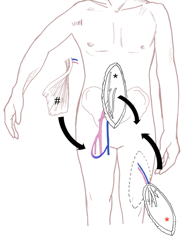 BOrmseth's tweet photo. Interesting graphic demonstrating different flap options that can be used in the treatment of perineal defects #plasticsurgery 
 
https://t.co/IMTQgqAKwN https://t.co/9fNDcllDya