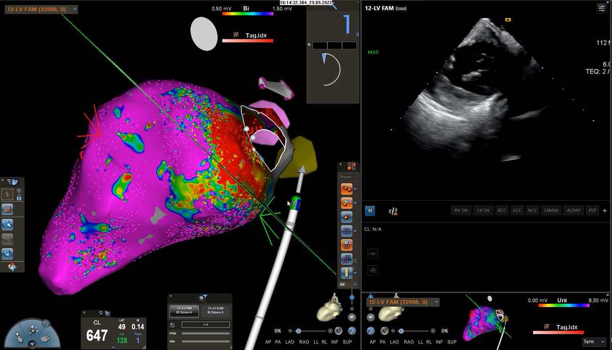 Timothy Markman (@dr_markman) on Twitter photo #EPeeps Venous EtOH for basal lateral epicardial substrate in pt with prior endo RFAx2 & tamponade w/ dense adhesions preventing epi access. Here during EtOH: lesion develops on ICE. Endo bipolar abnormality expands suggesting transmural lesion. <a href="/PennEPFellows/">Penn Electrophysiology Fellowship</a> @MiguelVldrbno #EPeeps Venous EtOH for basal lateral epicardial substrate in pt with prior endo RFAx2 & tamponade w/ dense adhesions preventing epi access. Here during EtOH: lesion develops on ICE. Endo bipolar abnormality expands suggesting transmural lesion. <a href="/PennEPFellows/">Penn Electrophysiology Fellowship</a> @MiguelVldrbno