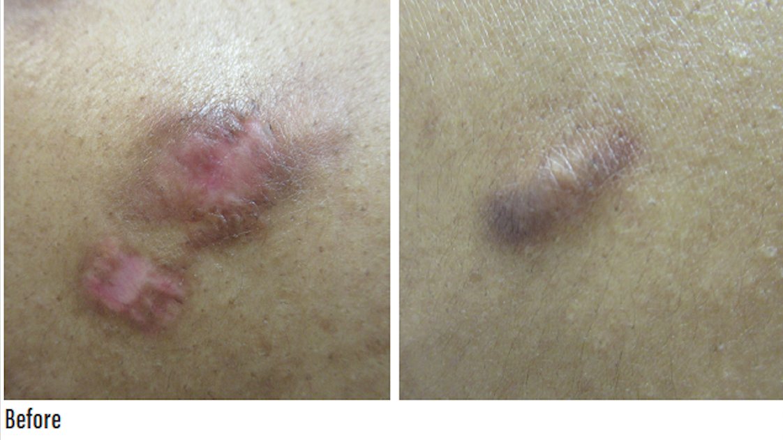 Practical_Derm's tweet photo. Keloid scarring has been considered an abnormal wound healing response, but new evidence suggests a potential underlying immune pathogenesis of type 2 lymphocytes in their formation. This is why @EmmaGuttman is investigating dupilumab for chronic #keloids: https://t.co/xzp8bsrgQt https://t.co/Smz0jgWZIQ