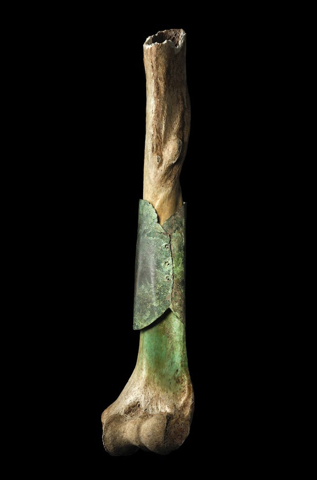 historydefined's tweet image. The Varnhem Humerus, a broken bone repaired with a copper plate, Varnhem, Västergötland. Dated between 13th and 16th century.