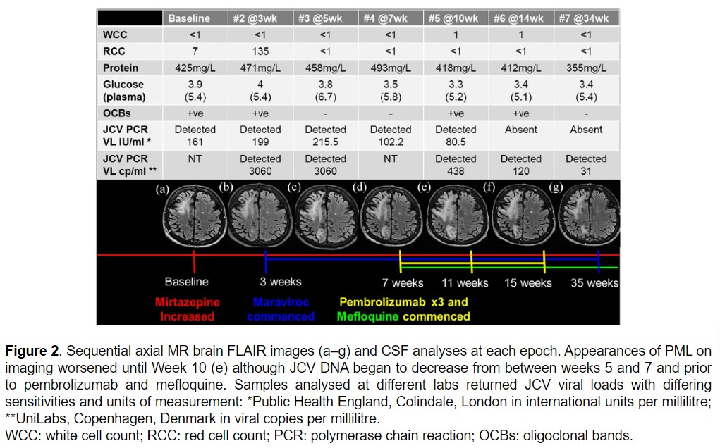 MSJ_Research's tweet photo. Look at MRI changes while treating fingolimod-associated progressive multifocal leukoencephalopathy with immune checkpoint inhibitors (pembrolizumab) 1/3🧵 https://t.co/Pxnl27rljd