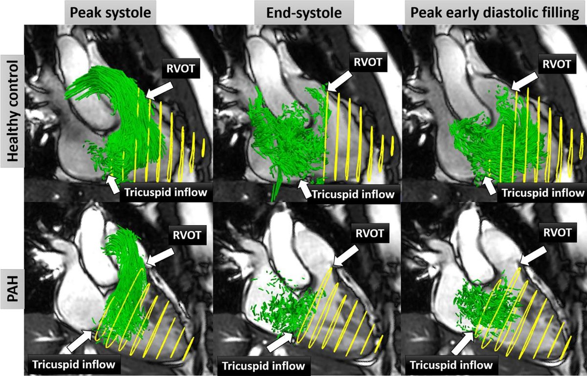 Liam Zhong (@lzhongnhc) on Twitter photo It is great collaboration to promote 4DFlow CMR in pulmonary arterial hypertension with reference to cardiopulmonary exercise test as outcome. 
jcmr-online.biomedcentral.com/articles/10.11… It is great collaboration to promote 4DFlow CMR in pulmonary arterial hypertension with reference to cardiopulmonary exercise test as outcome. 
jcmr-online.biomedcentral.com/articles/10.11…
