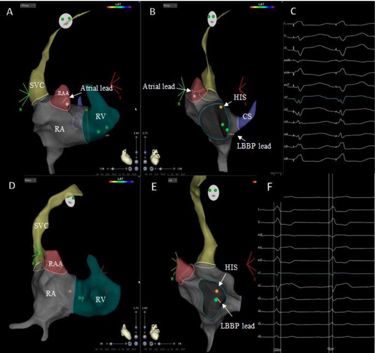 Javier Ramos Maqueda (@ramos__maqueda) on Twitter photo Happy to share our latest work in <a href="/ArritmiasHCUZ/">Arritmias H. Clínico Lozano Blesa. Zaragoza. Spain</a> just published in <a href="/JCardioEP/">Journal of Cardiovascular Electrophysiology</a> :
Feasibility and safety of ZERO‐fluoroscopy left bundle branch pacing.
onlinelibrary.wiley.com/share/author/R…
<a href="/ManoloMolina8/">Manuel Molina-Lerma</a> @miguelalvarlop <a href="/OCanoPerez/">Óscar Cano</a> <a href="/curilakarol/">curilakarol</a> <a href="/MdHuang/">Weijian Huang</a> @estimcardiaca #EPeeps #zerofluoro Happy to share our latest work in <a href="/ArritmiasHCUZ/">Arritmias H. Clínico Lozano Blesa. Zaragoza. Spain</a> just published in <a href="/JCardioEP/">Journal of Cardiovascular Electrophysiology</a> :
Feasibility and safety of ZERO‐fluoroscopy left bundle branch pacing.
onlinelibrary.wiley.com/share/author/R…
<a href="/ManoloMolina8/">Manuel Molina-Lerma</a> @miguelalvarlop <a href="/OCanoPerez/">Óscar Cano</a> <a href="/curilakarol/">curilakarol</a> <a href="/MdHuang/">Weijian Huang</a> @estimcardiaca #EPeeps #zerofluoro