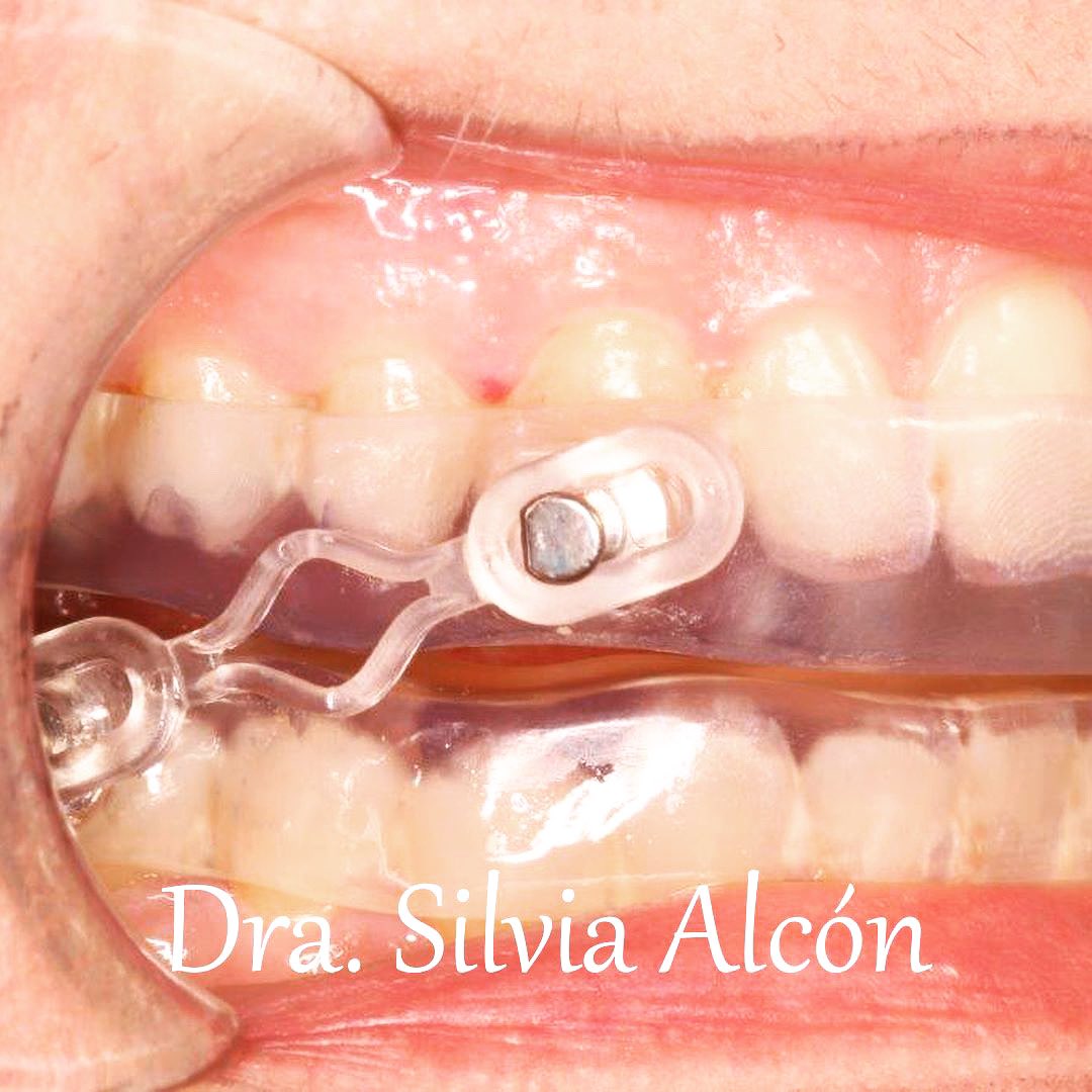 DraSilviaAlcon's tweet photo. 🦷 Gracias a los dispositivos de avance mandibular, los pacientes con #apnea leve y/o moderada pueden ser diagnosticados y tratados en #clínicasdentales por medio de las #férulas personalizadas. #Ortodoncista #DentistaGetafe #OrtodoncistaGetafe #Salcodent #ApneaDelSueño #Apnia https://t.co/PGJi7X2ux9