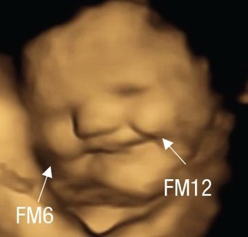 İlk fotoğraf anne lahana yedikten sonra fetusun 4 boyutlu ultrasonla görüntülenen yüzü, 2. fotoğraf anne havuç yedikten sonraki yüzü (32-36 haftalık gebelik).
Anne karnındaki fetus lezzetleri algılıyor ve tepki veriyor.
Bilim ❤️