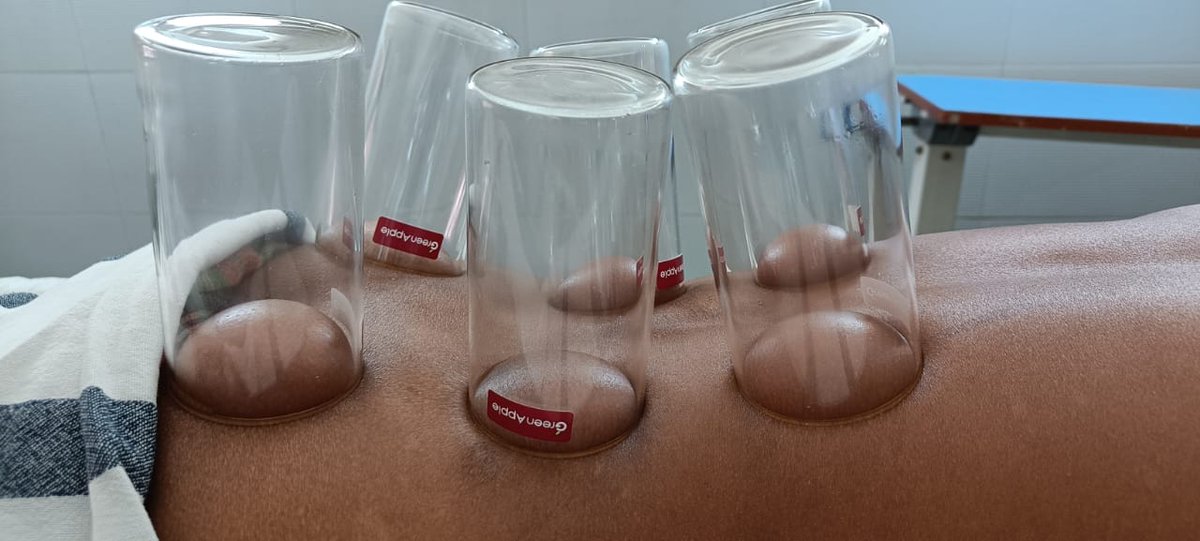 Cupping Therapy(Dry) for Low #backpain <a href="/AIIMSBhubaneswr/">AIIMS Bhubaneswar</a>.One of the effective procedures in back pain case,also in  Lumbosacral painful conditions. Dept of AYUSH started treatment for LBA cases through non-invasive procedures like Yoga,Panchakarma &amp; Cupping therapy.
<a href="/MoHFW_INDIA/">Ministry of Health</a>