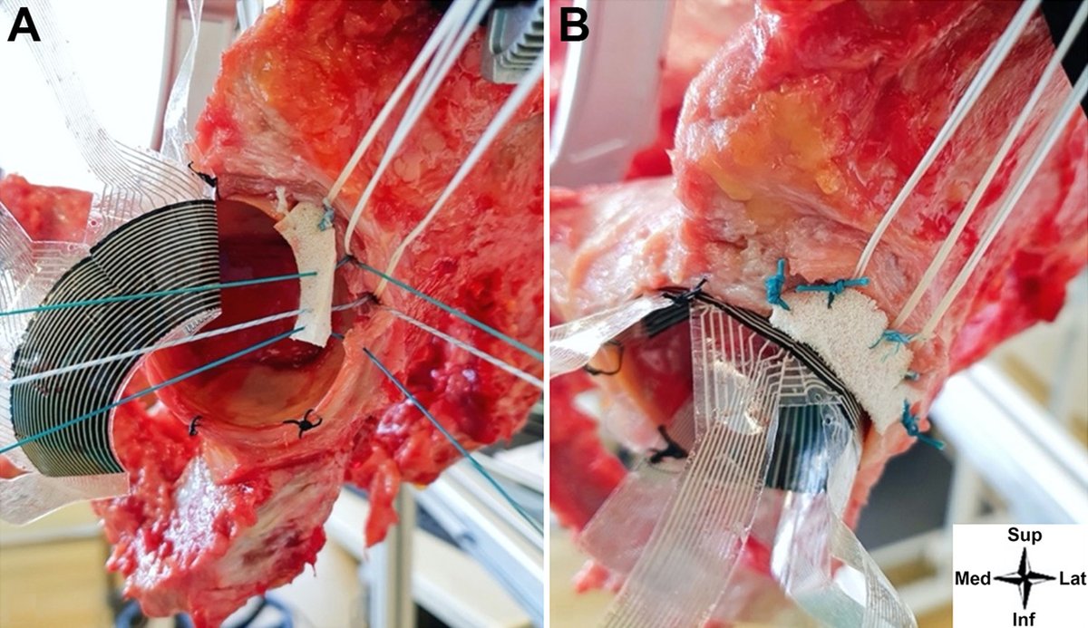 OJSM_SportsMed's tweet photo. Hip labrum reconstruction after partial lobectomy using a synthetic polyurethane scaffold improved hip joint kinetics and restored hip labrum suction seal in most specimens. #hiparthroscop #labralreconstruction #FAI #hipsurgery, @DrBrunoCapurro 
https://t.co/5Yzoghru55 https://t.co/hH4nRACMbb