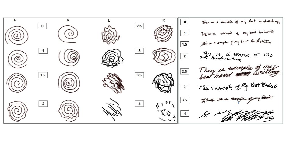 tychicuschen's tweet photo. Useful examples for scoring spirals and handwriting in essential tremor using the TETRAS score - a scale from 0-4 (with .5 increments)
✍️
Ref: https://t.co/juS75nkeDi https://t.co/PWCimWnCoH