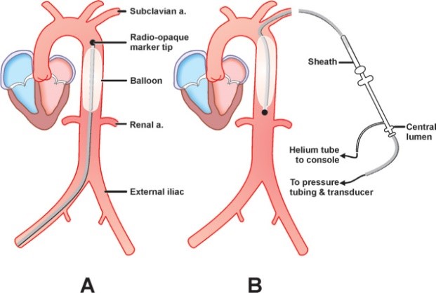 mesh pit genie Mechanical Life Support on Twitter: "Device of the day - Intra-Aortic Balloon Pump (IABP) The most widely used circulatory support device – cheap, low cost, with relatively few complications. The IABP is mesh pit genie Mechanical Life Support on Twitter: "Device of the day - Intra-Aortic Balloon Pump (IABP) The most widely used circulatory support device – cheap, low cost, with relatively few complications. The IABP is