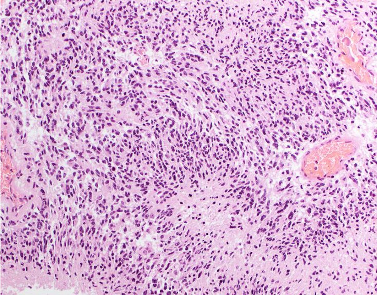 BWHPath's tweet photo. A pt presents w/an intracranial enhancing non-expansile mass in the parietal lobe and extending into the ipsilateral temporal lobe. Biopsies taken during a craniotomy show the following. What is your DDx? What additional studies would you do? #BWHPathCotW #BWHNeuroPathWinter

1/ https://t.co/UT9GMJMcO9