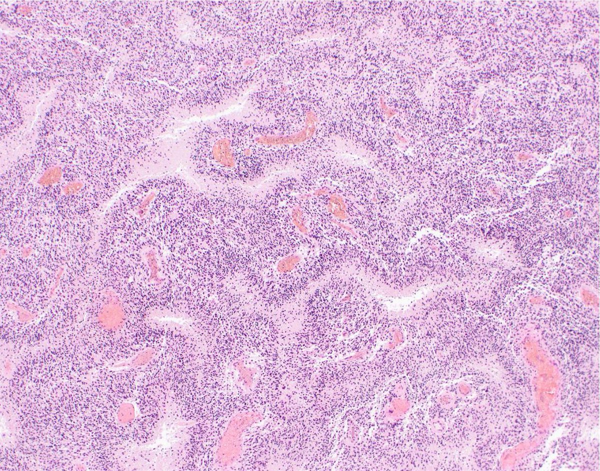 A pt presents w/an intracranial enhancing non-expansile mass in the parietal lobe and extending into the ipsilateral temporal lobe. Biopsies taken during a craniotomy show the following. What is your DDx? What additional studies would you do? #BWHPathCotW #BWHNeuroPathWinter

1/