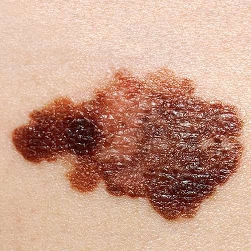 A genetic marker can identify patients at high risk of potentially serious side effects from immunotherapy used to treat melanoma skin cancer. Researchers identified the first genetic risk factor for immunotherapy toxicity in the IL-7 gene. Learn more: ow.ly/PhZU50M198z
