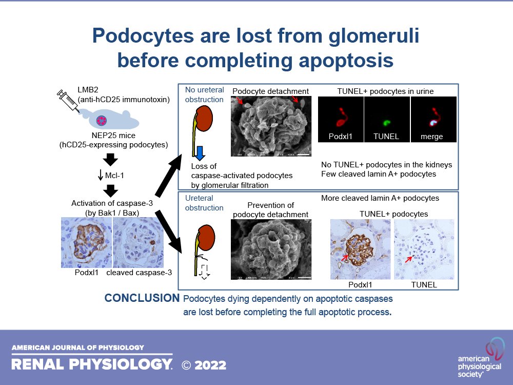 🌟RESEARCH🌟
By: Podocytes are lost from glomeruli before completing apoptosis
Kazuyoshi Yamamoto, Masahiro Okabe, Keiko Tanaka, Takashi Yokoo, Ira Pastan, Toshikazu Araoka, Kenji Osafune, Tomohiro Udagawa, Masahiro Koizumi, and Taiji Matsusaka  
ow.ly/HgYb50M1jpb