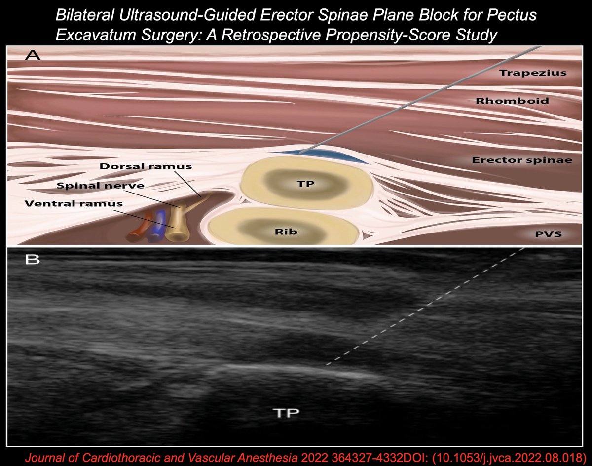 ✅Erector spinae plane block effective option for pain management after surgical repair of #PectusExcavatum as part of a multimodal approach. 
✅Good perioperative analgesia, opioid sparing, and reduced opioid-related adverse effects. #RegionalAnesthesia
jcvaonline.com/article/S1053-…