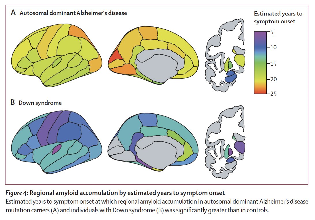 Congratulations to Anna Boerwinkle &amp; <a href="/abc_ds_/">Alzheimer Biomarkers Consortium — Down Syndrome</a> team on publishing this article in <a href="/TheLancetNeuro/">The Lancet Neurology</a>! 'Comparison of amyloid burden in individuals with #DownSyndrome versus autosomal dominant AD: a cross-sectional study' shows individuals with DS might benefit from early intervention
