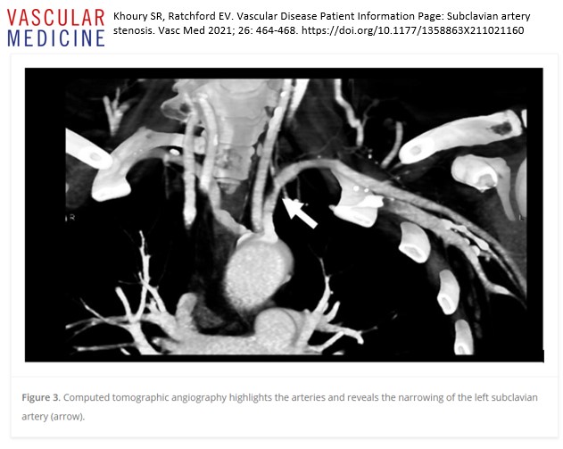 #12DaysofVascularMedicine starts TODAY! The most read #patientinfo page of 2022 is “Subclavian artery stenosis” by @shireen_khoury @evratchford journals.sagepub.com/doi/abs/10.117…